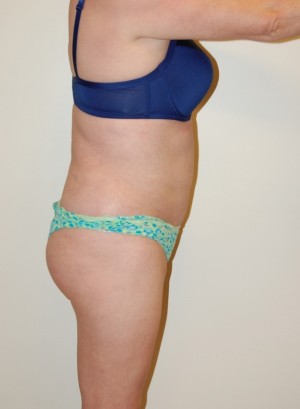 Liposuction Case 2026 After Photo Liposuction