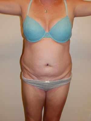 Liposuction Case 2026 Before Photo Liposuction