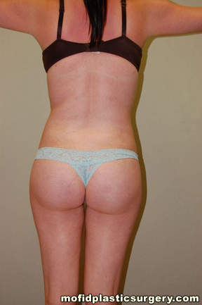 Buttock Lift Case 2066 After Photo Buttock Lift