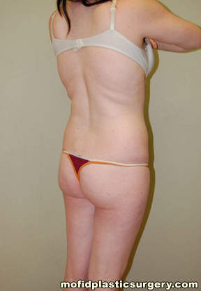 Buttock Lift Case 2066 Before Photo Buttock Lift