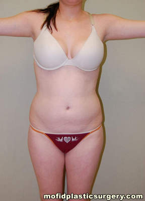 Buttock Lift Case 2066 Before Photo Buttock Lift
