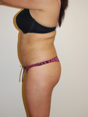 Buttock Lift Case 2096 After Photo Buttock Lift