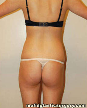 Buttock Lift Case 2104 Before Photo Buttock Lift