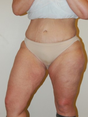 Inner Thigh Lift Case 2126 Before Photo Inner Thigh Lift