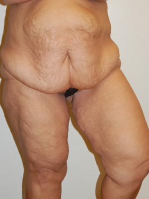 Inner Thigh Lift Case 2130 Before Photo Inner Thigh Lift