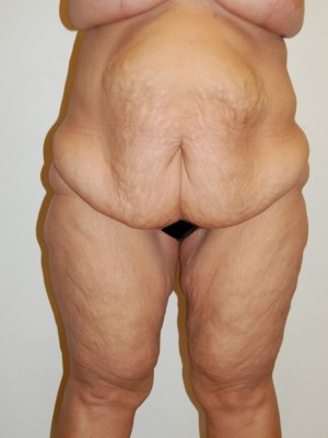 Inner Thigh Lift Case 2130 Before Photo Inner Thigh Lift
