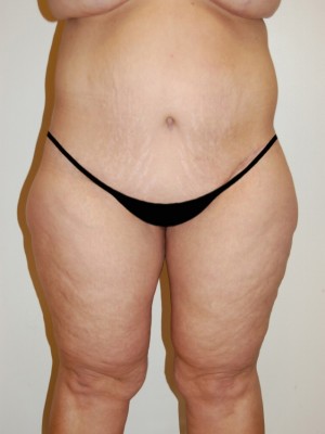 Inner Thigh Lift Case 2130 After Photo Inner Thigh Lift