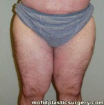Inner Thigh Lift