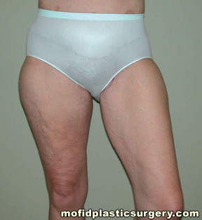 Inner Thigh Lift Case 2140 After Photo Inner Thigh Lift