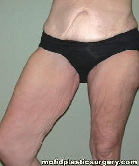 Inner Thigh Lift Case 2140 Before Photo Inner Thigh Lift