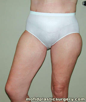 Inner Thigh Lift Case 2140 After Photo Inner Thigh Lift