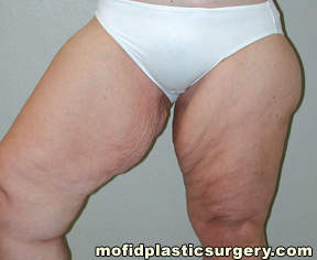 Inner Thigh Lift Case 2152 Before Photo Inner Thigh Lift