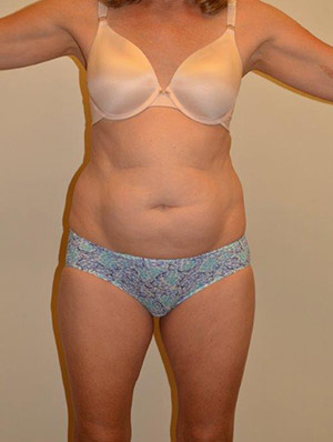 Liposuction Case 2160 Before Photo Liposuction