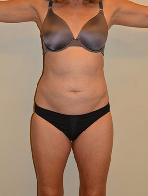 Liposuction Case 2160 After Photo Liposuction
