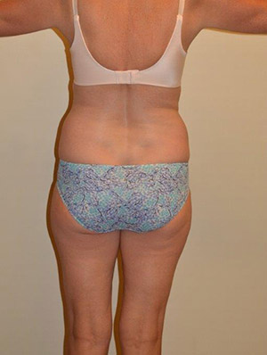 Liposuction Case 2160 Before Photo Liposuction