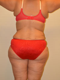 Liposuction Case 2176 After Photo Liposuction