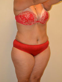 Liposuction Case 2176 After Photo Liposuction