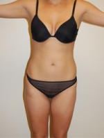 Liposuction