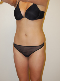 Liposuction Case 2186 Before Photo Liposuction