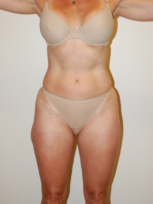 Liposuction Case 2196 Before Photo Liposuction