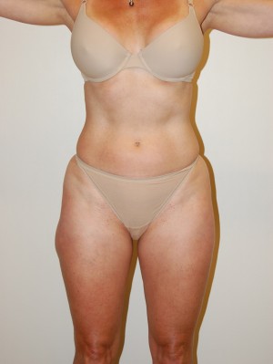 Liposuction