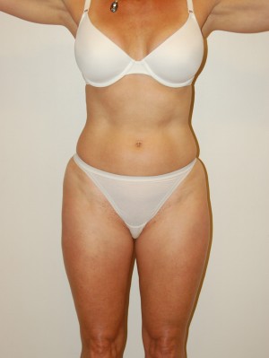 Liposuction Case 2196 After Photo Liposuction