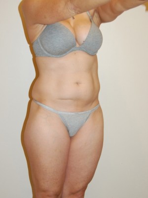 Liposuction Case 2204 Before Photo Liposuction