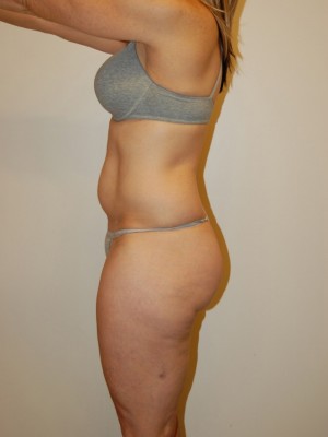 Liposuction Case 2204 Before Photo Liposuction