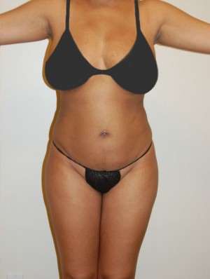 Liposuction Case 2224 After Photo Liposuction