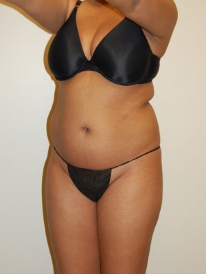 Liposuction Case 2224 Before Photo Liposuction