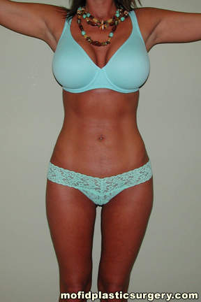 Liposuction Case 2232 After Photo Liposuction
