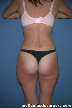 Liposuction Case 2232 Before Photo Liposuction