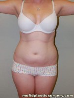 Liposuction