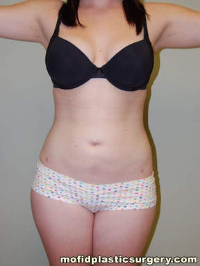 Liposuction