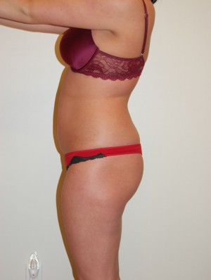 Liposuction Case 2248 Before Photo Liposuction