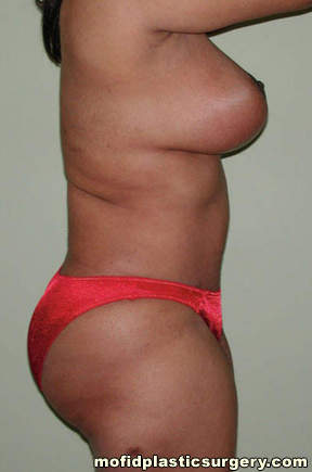 Liposuction Case 2258 After Photo Liposuction