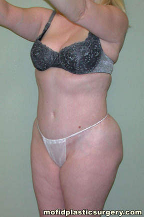 Liposuction Case 2266 Before Photo Liposuction