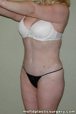 Liposuction Case 2266 After Photo Liposuction