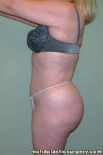 Liposuction