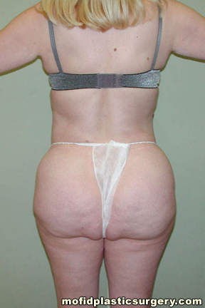 Liposuction Case 2266 Before Photo Liposuction