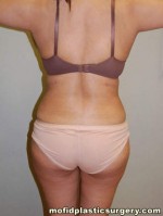 Liposuction