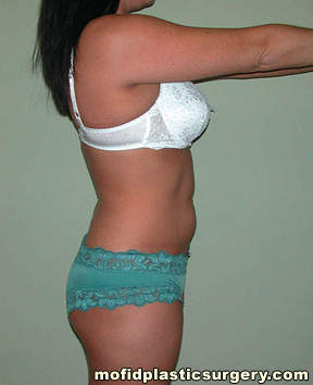 Liposuction Case 2280 Before Photo Liposuction
