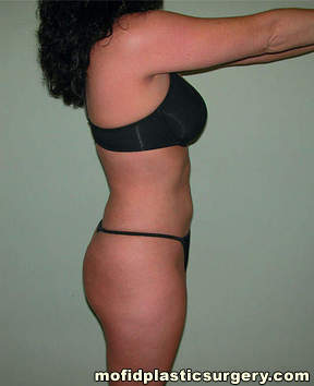 Liposuction Case 2280 After Photo Liposuction