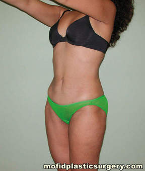Liposuction Case 2288 After Photo Liposuction
