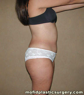 Liposuction Case 2288 Before Photo Liposuction