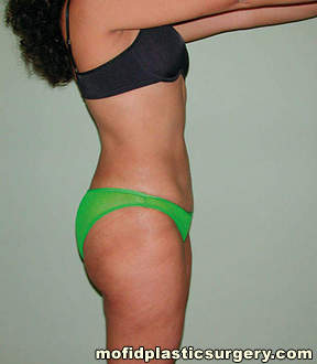 Liposuction Case 2288 After Photo Liposuction