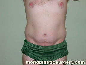 Liposuction Case 2306 Before Photo Liposuction