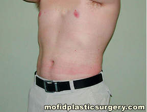 Liposuction Case 2306 After Photo Liposuction