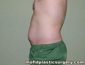 Liposuction Case 2306 Before Photo Liposuction