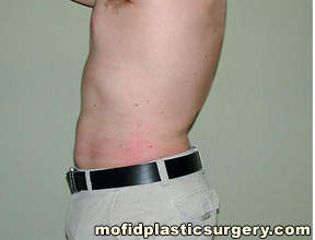 Liposuction Case 2306 After Photo Liposuction